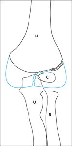 Fracture_Lateral condyle_Figure 1_1132801-Lateral-condyle-undisplaced AP_drawing.jpg